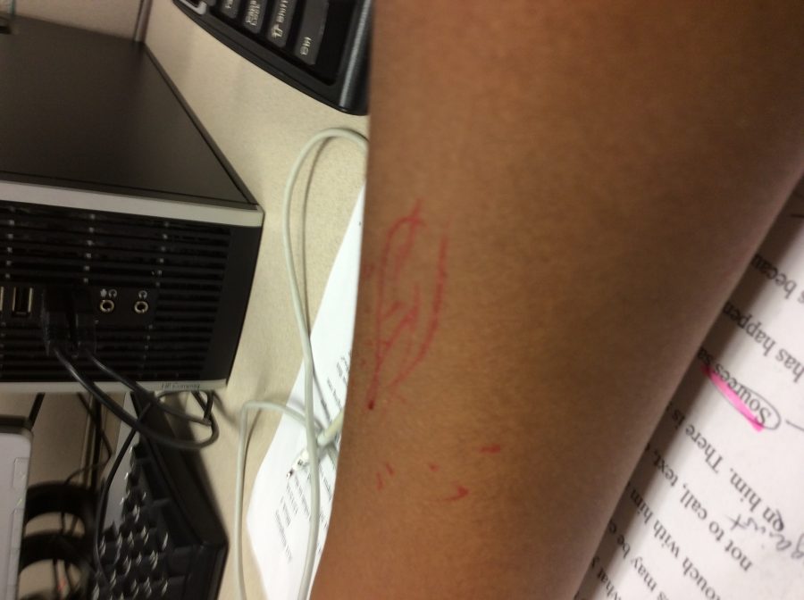 Lupus creates red spots on the skin